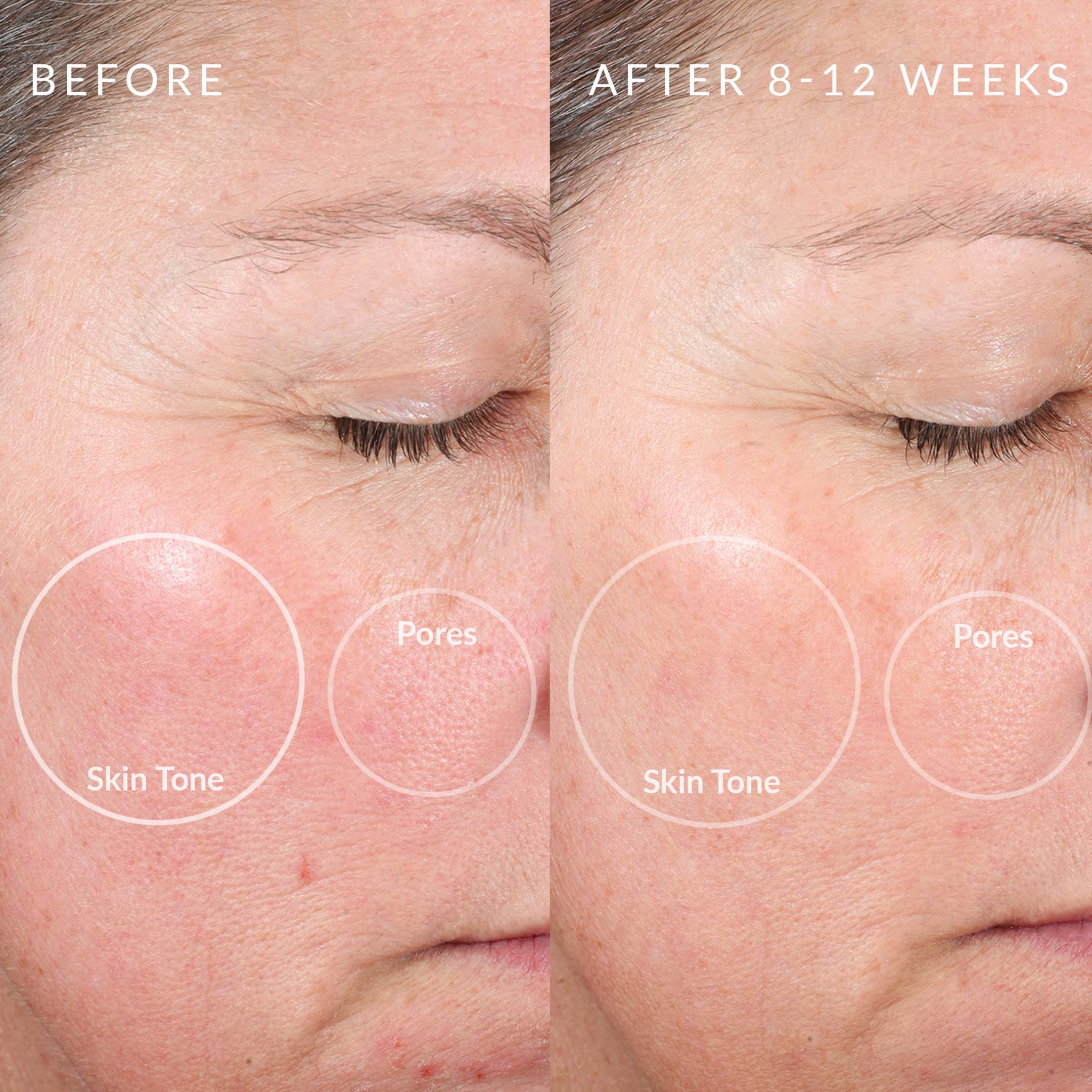 PMD Personal Microderm Elite Pro - Advanced At-Home Microdermabrasion Tool - Image 4